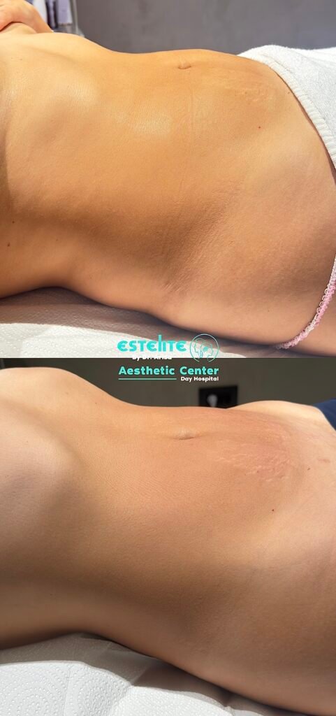 Manual Lymphatic Drainage ,Estelite
