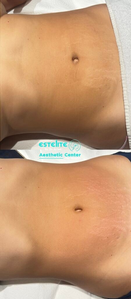 Manual Lymphatic Drainage, Estelite